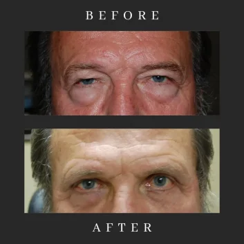 Best Male Blepharoplasty