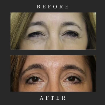 Before and after ptosis repair