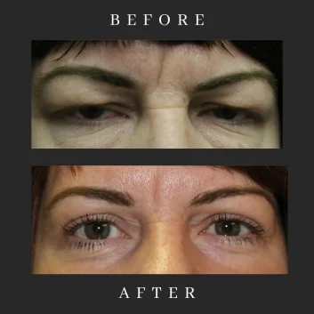 upper eyelid blepharoplasty RESULT