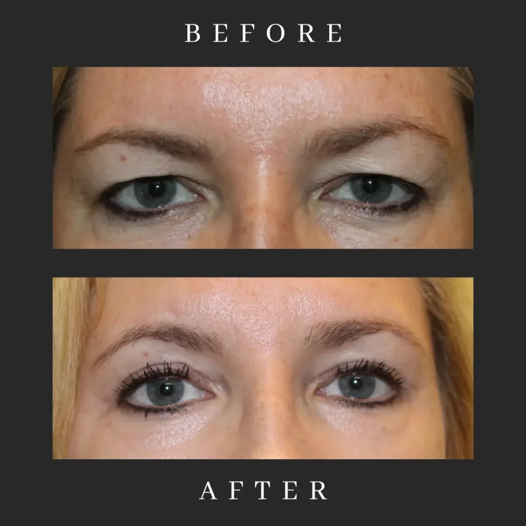 After Blepharoplasty & Canthopexy