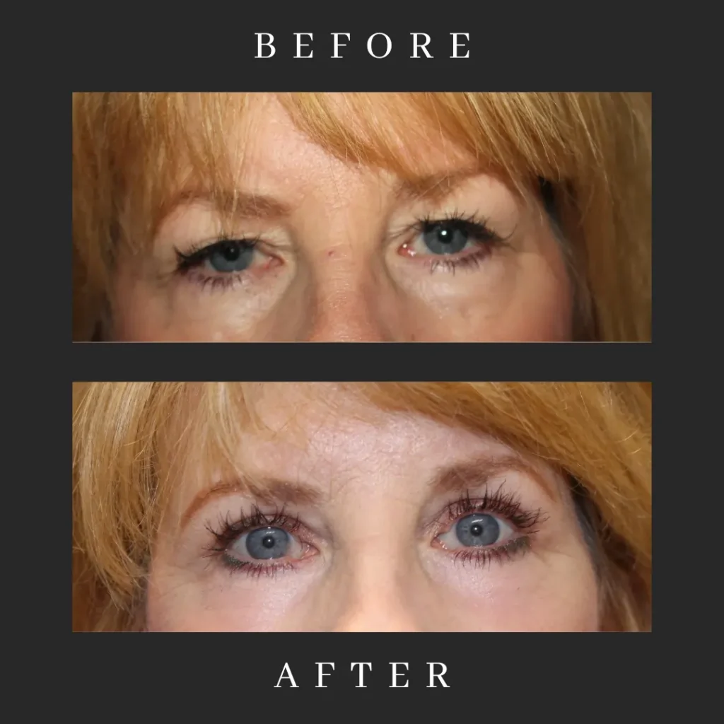 After Blepharoplasty and CO2 Laser Resurfacing