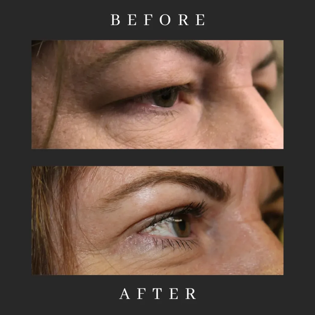 After Laser-Assisted Eyelid Surgery