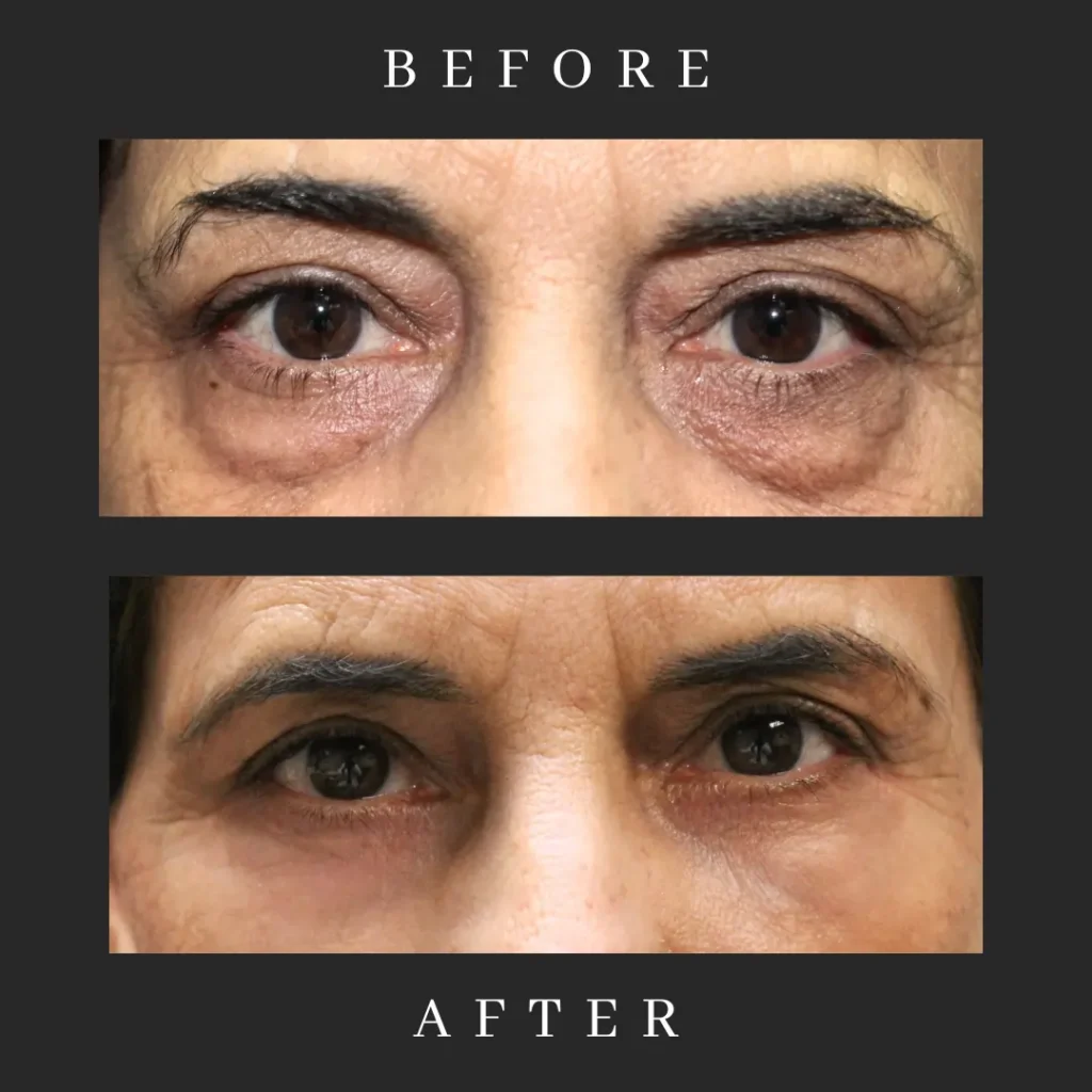 After Lower Blepharoplasty