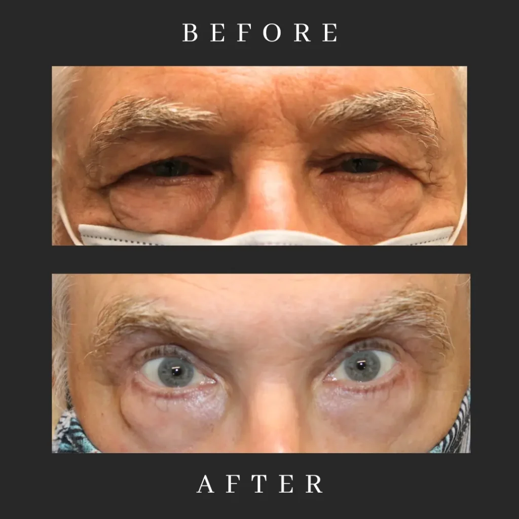 After Male Blepharoplasty