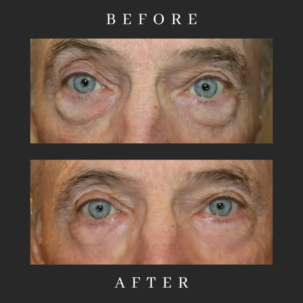 After Male Lower Blepharoplasty