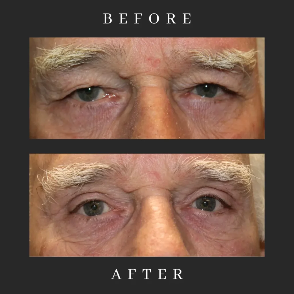 Before and After Male Blepharoplasty