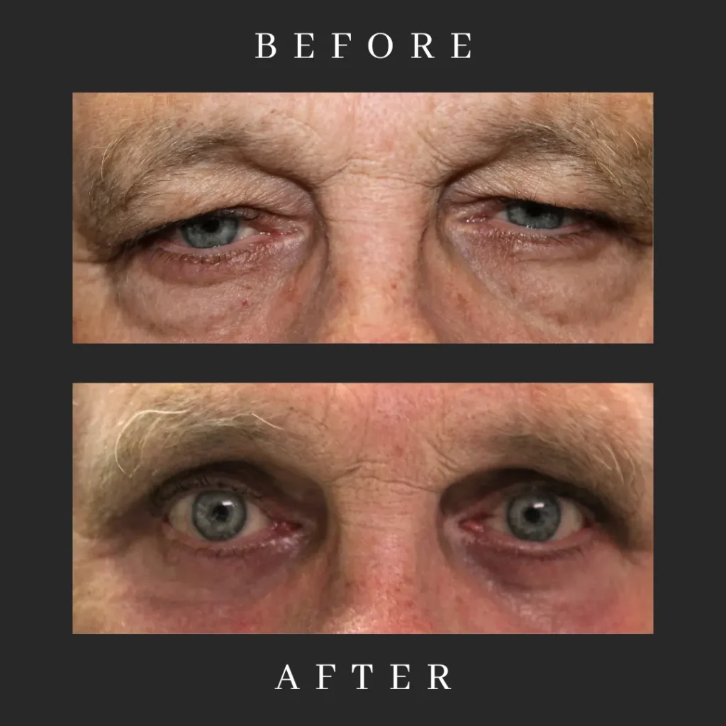 Before and After Male Blepharoplasty