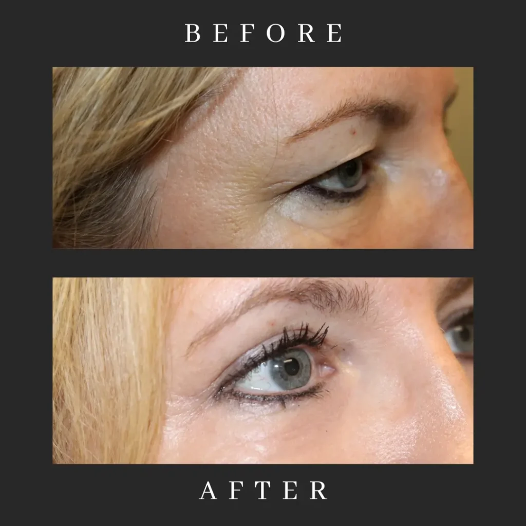 Blepharoplasty & Canthopexy