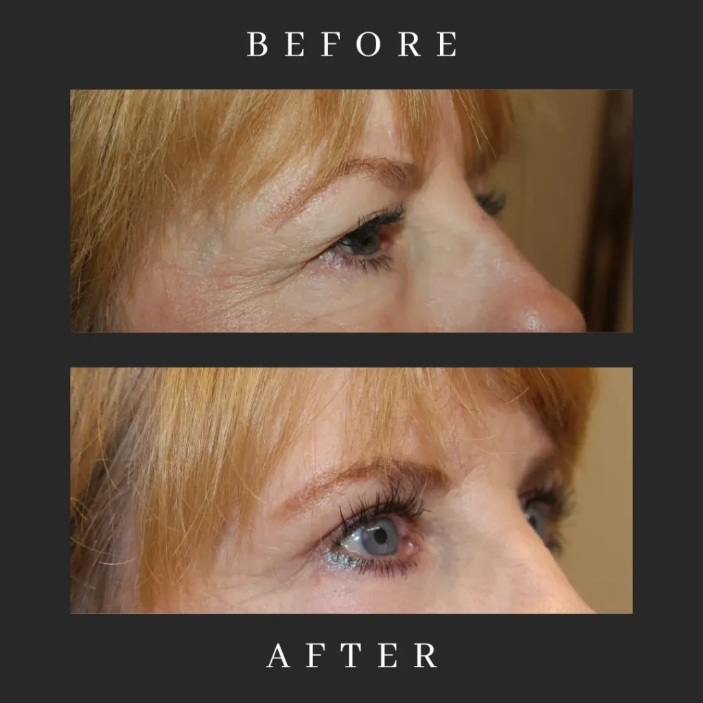 Blepharoplasty & Canthopexy Results