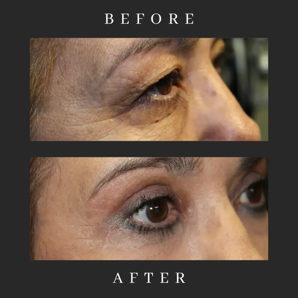 Blepharoplasty and CO2 Laser Resurfacing