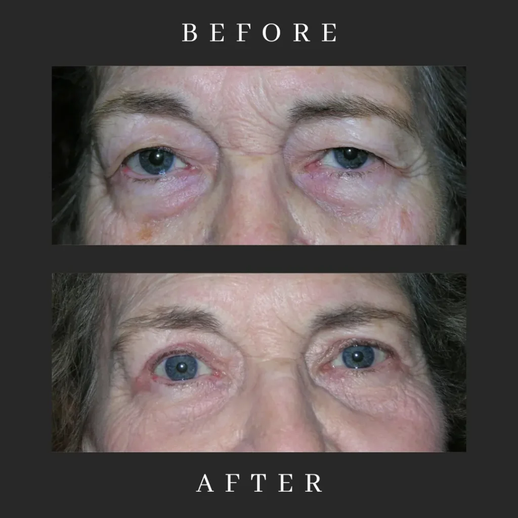 Blepharoplasty and CO2 Laser Resurfacing