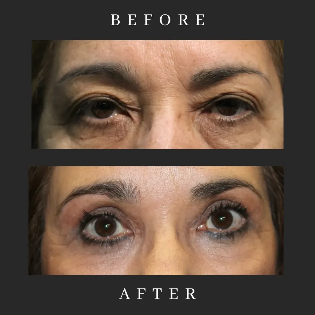 Blepharoplasty and CO2 Laser Resurfacing Results