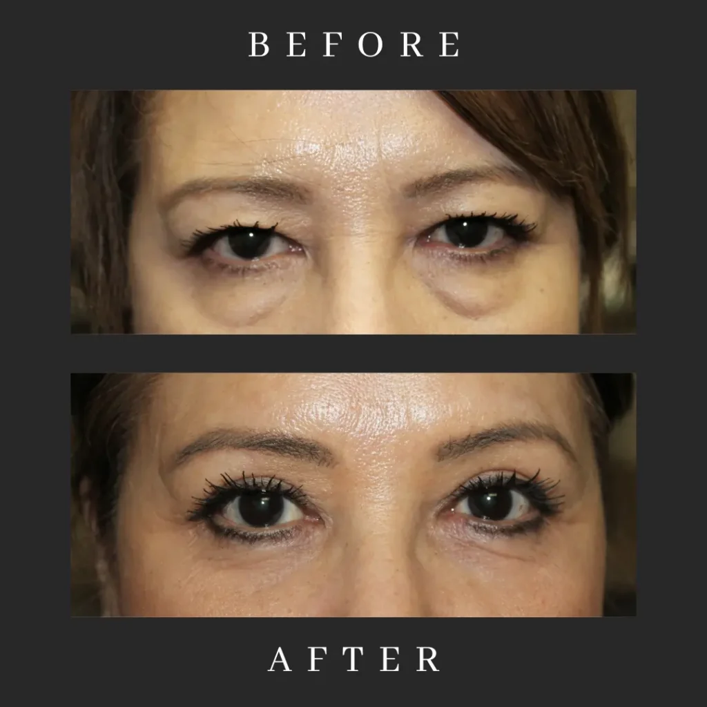 Laser-Assisted Eyelid Surgery