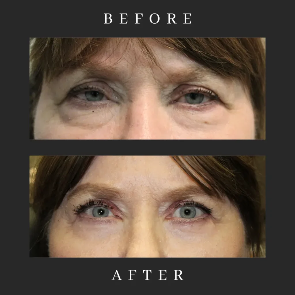 Laser-Assisted Eyelid Surgery