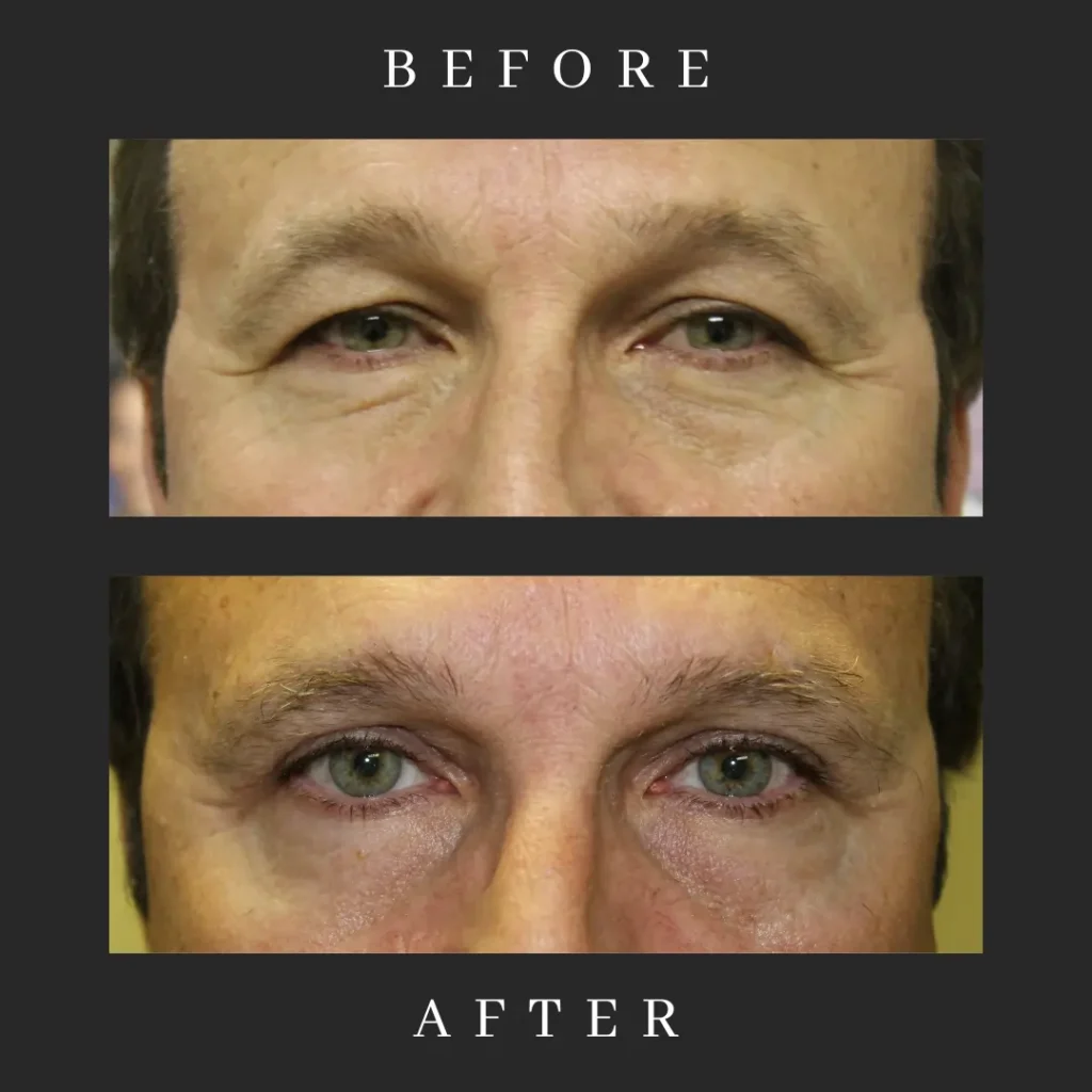 Laser-Assisted Eyelid Surgery Results