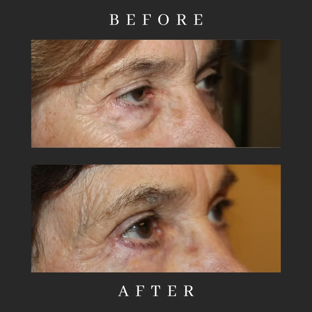 Lower Blepharoplasty