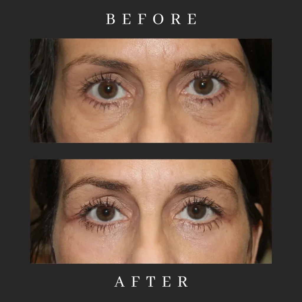 Lower Eyelid Blepharoplasty