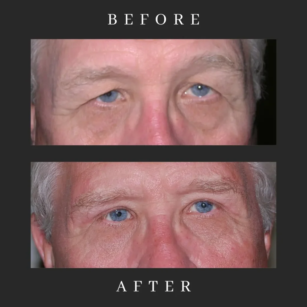 Male Blepharoplasty