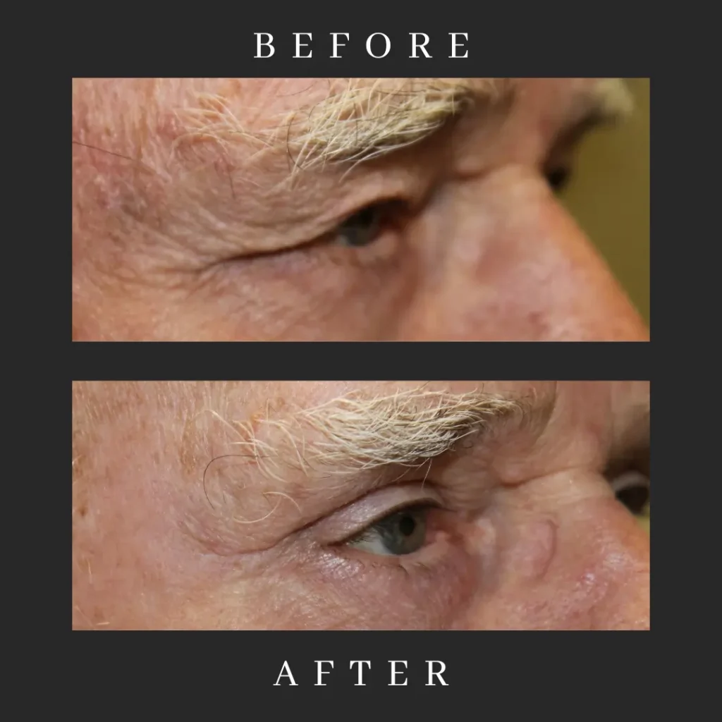 Male Blepharoplasty