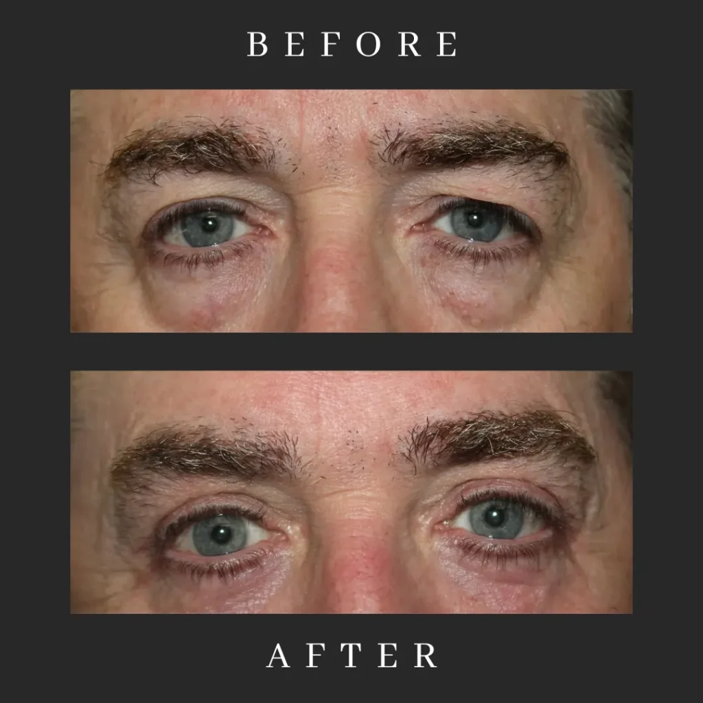 Male Blepharoplasty Results