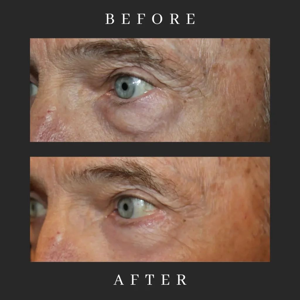 Male Lower Blepharoplasty