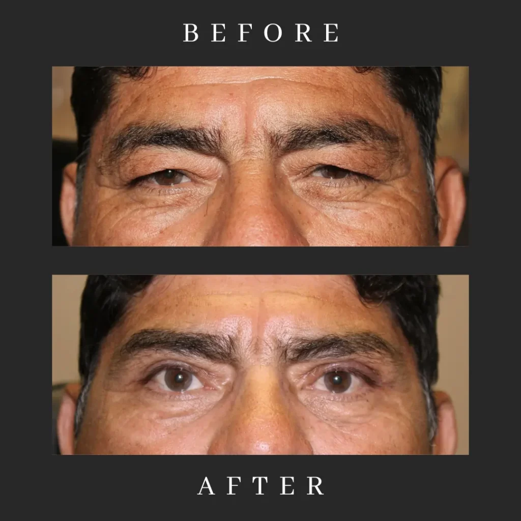 Outcome Male Blepharoplasty