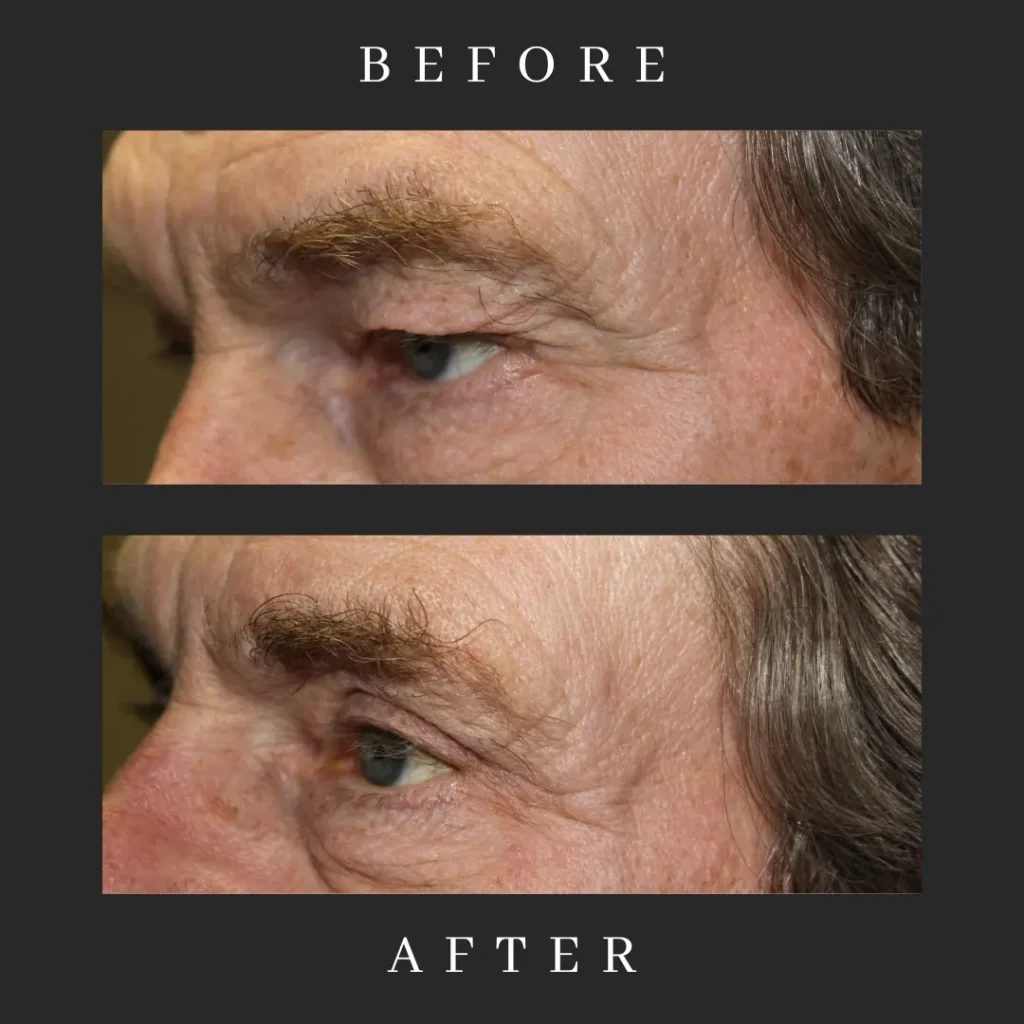 Outcome Male Blepharoplasty