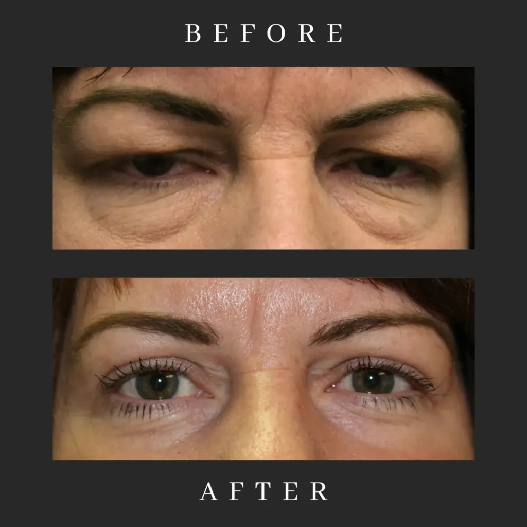 Ptosis Repair