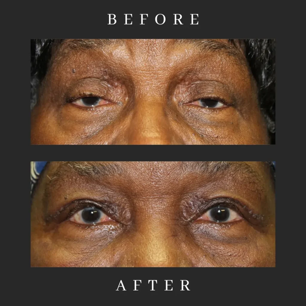 Ptosis Repair Results