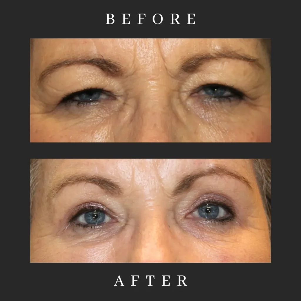 Ptosis Repair Results