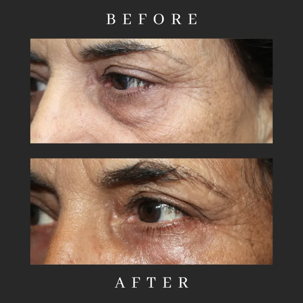 Results Lower Eyelid Blepharoplasty