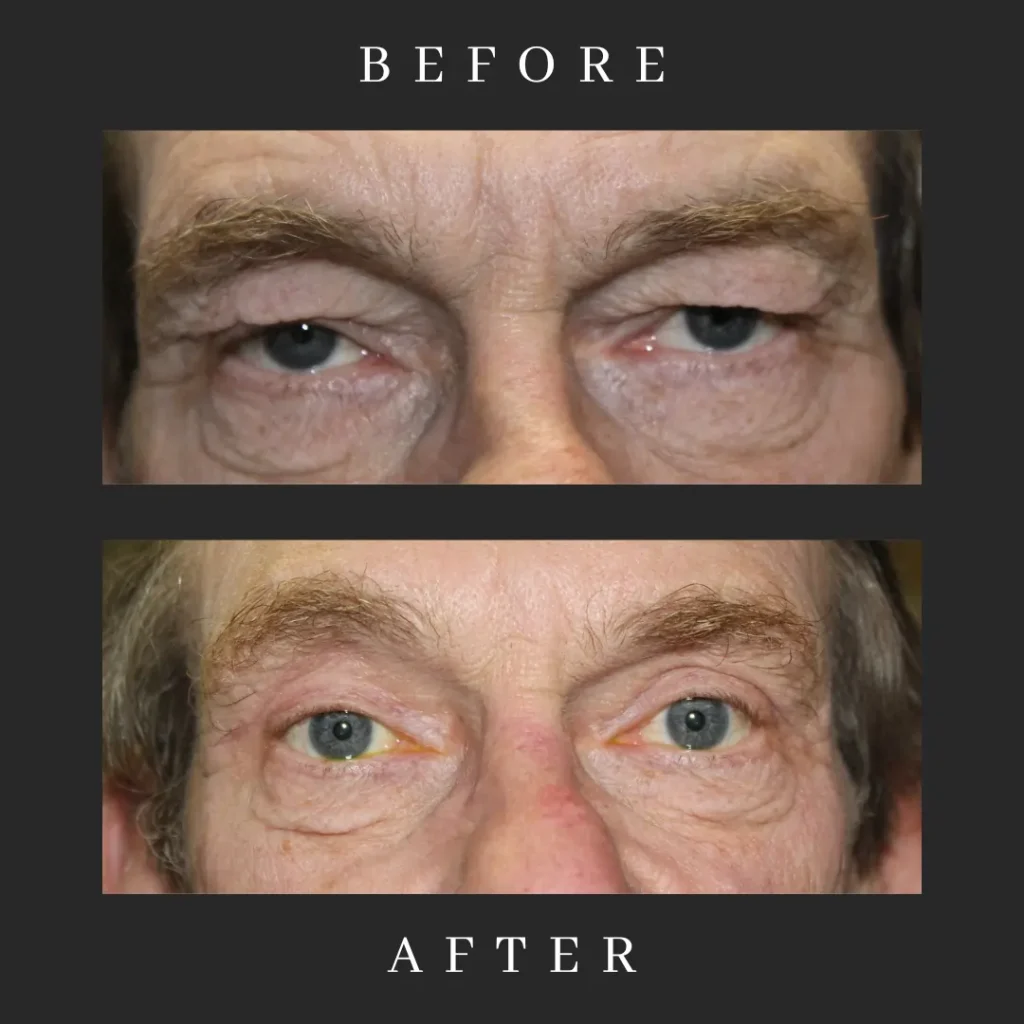 Results Male Blepharoplasty