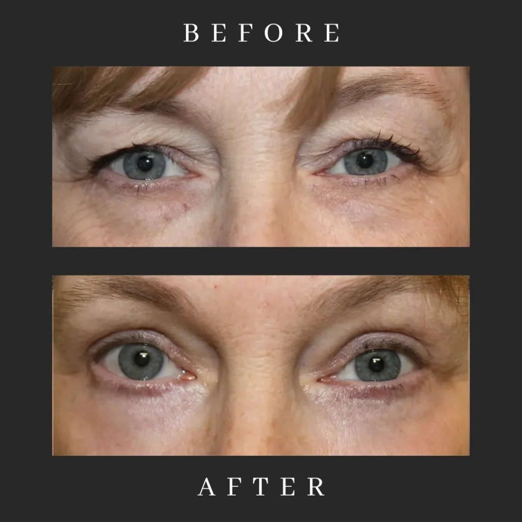 Results Upper Eyelid Blepharoplasty