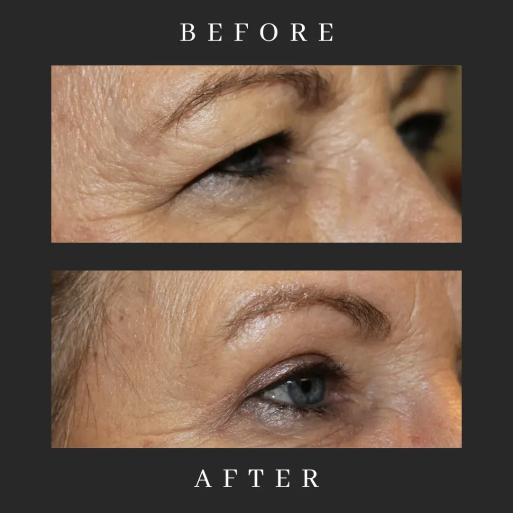 Upper Blepharoplasty