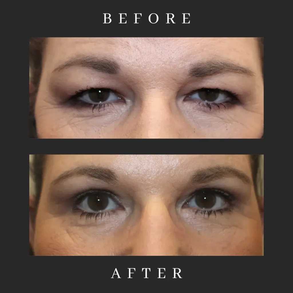 Upper Blepharoplasty