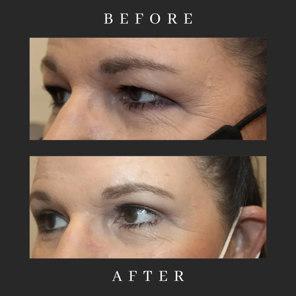 Upper Eyelid Blepharoplasty