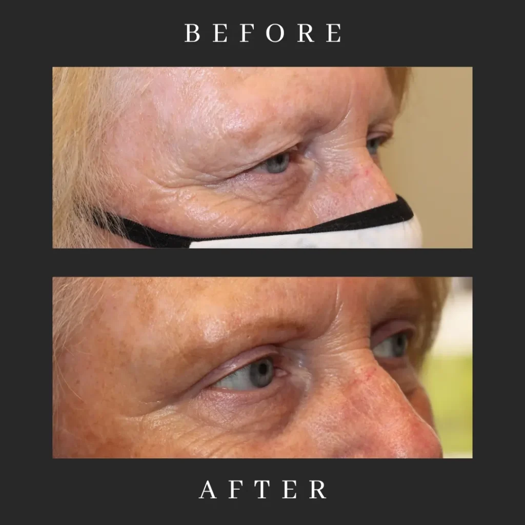 Upper Male Blepharoplasty